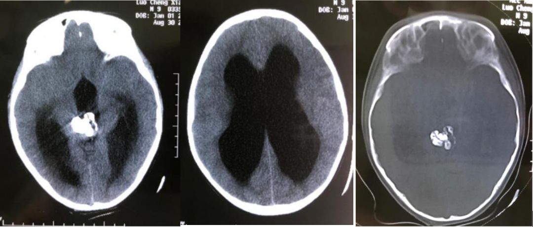 图1 头颅ct提示松果体区占位,可见颗粒样钙化斑,伴梗阻性脑积水.