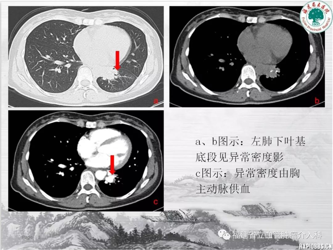 这是啥疾病 肺部隔离症?