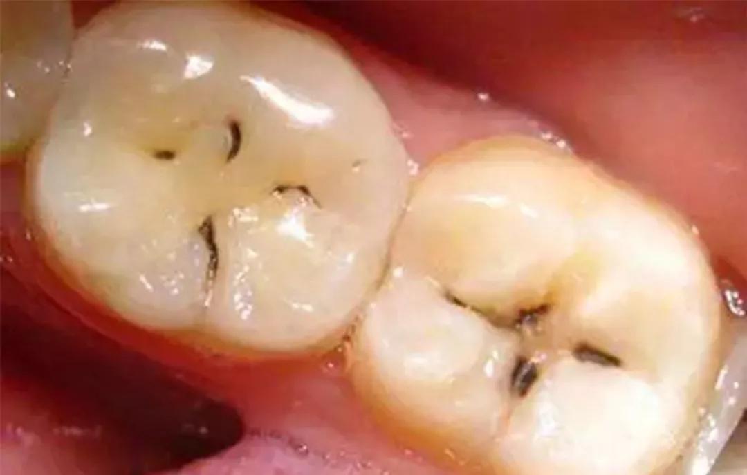 牙齿咀嚼面上出现黑色的线条,不管多用力刷牙都刷不掉.
