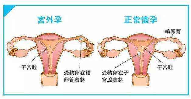 7年4次宫外孕!切除了一根输卵管,女子为何仍被宫外孕缠上?