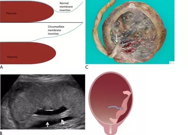 一文读懂正常与异常胎盘的超声表现