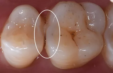 还有一种龋齿从牙齿邻面和牙齿窝沟线开始向内开拓领地的,也是不容易