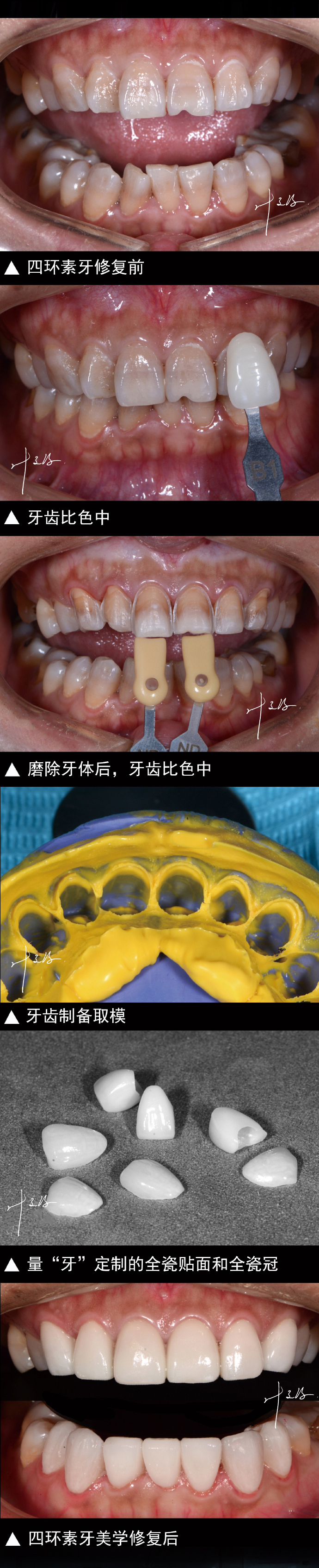 四环素牙 61 美学修复案例分享_牙齿