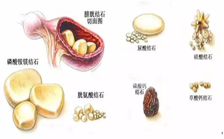 常见成分有草酸盐,磷酸盐,碳酸盐,胱氨酸等,多数结石混合两种或两种