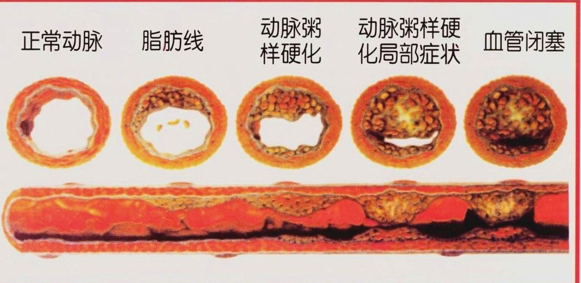 颈动脉一堵,卒中防不胜防!中老年人别再陷入这3个常见误区
