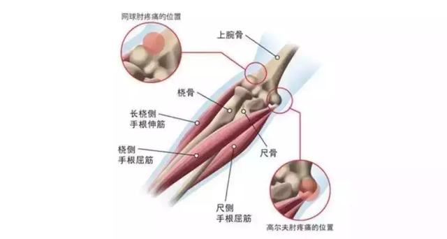 胳膊肘子酸痛怎么办