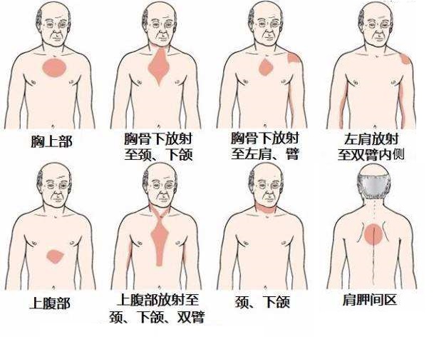 出现这5个胸痛特征,十有八九就
