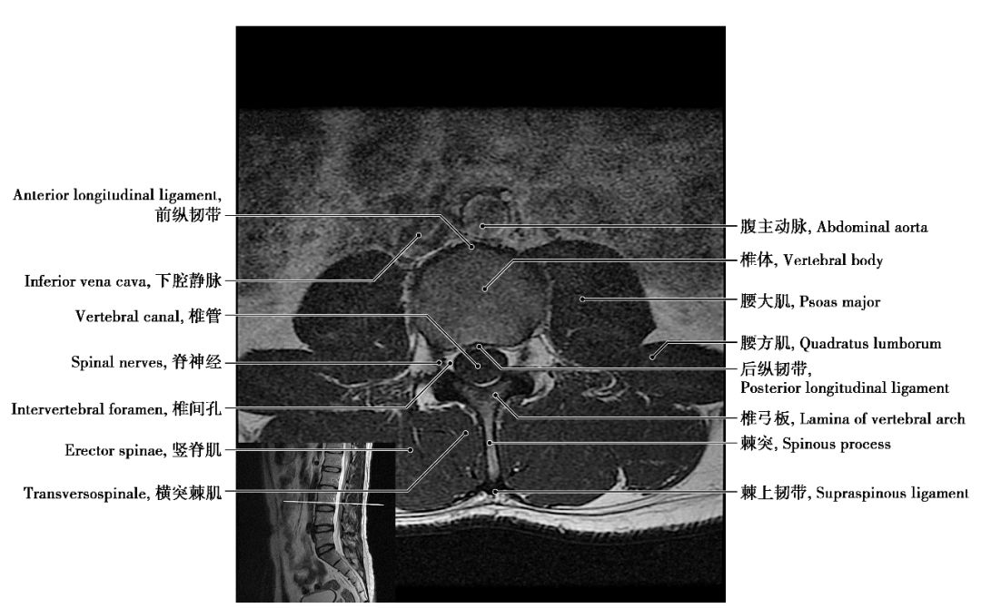 中枢神经系统影像解剖图谱连载3腰椎mri概论t1wi轴位解剖图