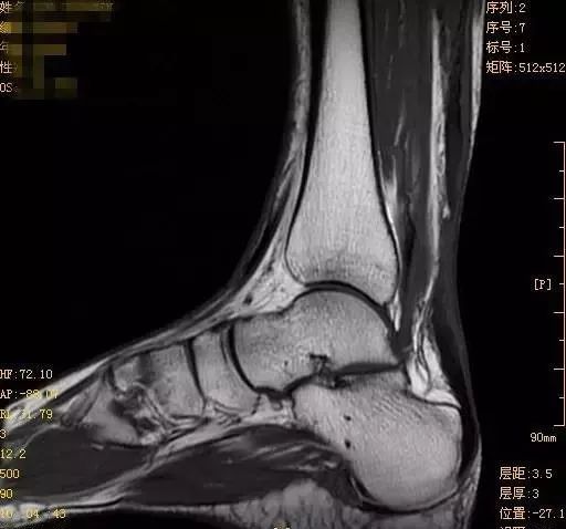 终于找到跟腱受伤后还能运动的方法了，专家提示：1个方法，帮你恢复 肌腱