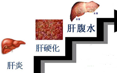 腹水,故诊断为原发性胆汁性肝硬变; (2)肝硬化基础上出现消化道出血