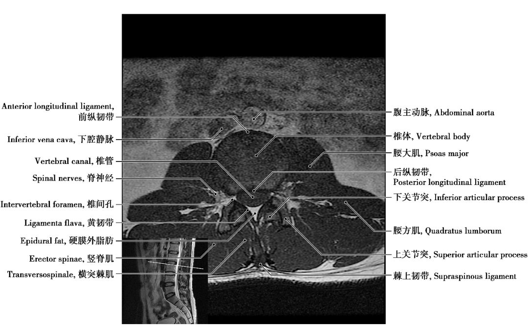 中枢神经系统影像解剖图谱连载3| 腰椎mri概论 t1wi轴位解剖图