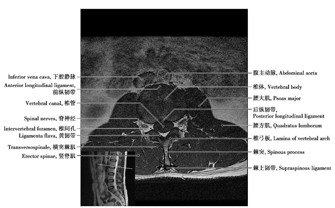 中枢神经系统影像解剖图谱连载3腰椎mri概论t1wi轴位解剖图