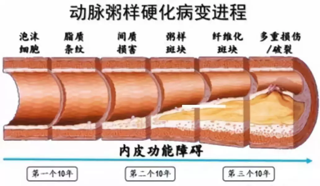 动脉粥样硬化的预防