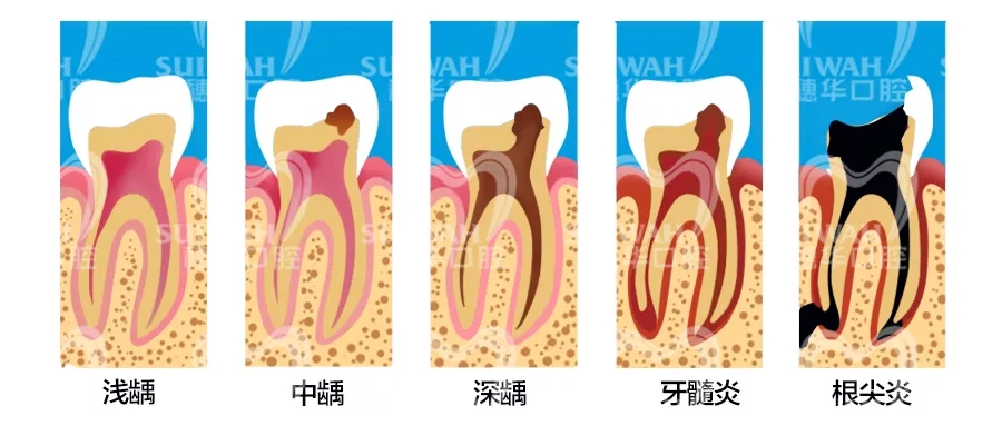 吃雪糕牙疼怎么办