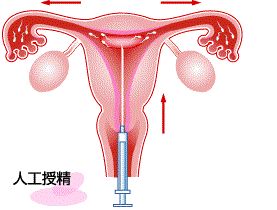 试管中心大夫教您正确认识"人工授精"