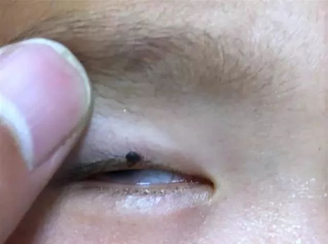 2岁娃眼皮上突然冒出一个小黑点!医生:这东西会要命! 色噜噜,日夜噜在线视频