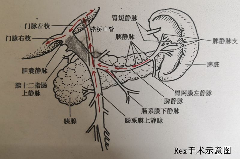 首例门静脉海绵样变改良rex手术在普外一科完成