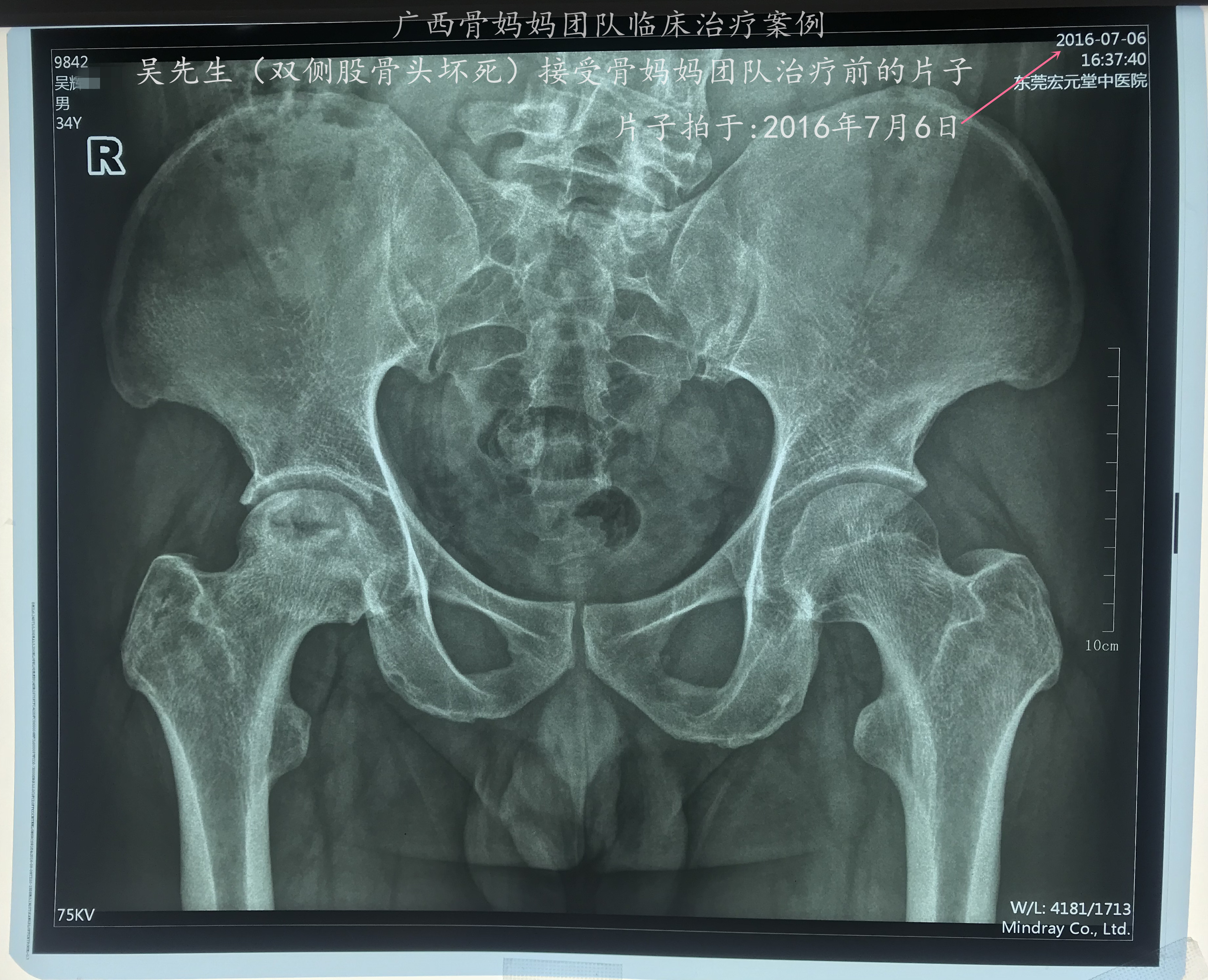 股骨头坏死中医治疗成功案例分享:这个患者治疗全程x线片的变化亮眼