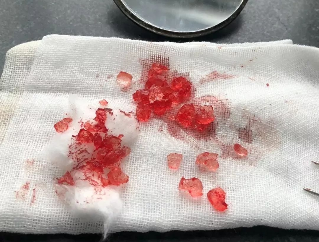                     淄博1岁宝宝鼻腔进异物，小米粒涨成“水晶球”！这种东西太可怕！