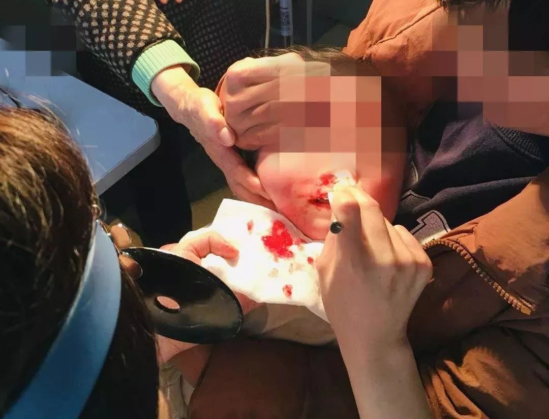                     淄博1岁宝宝鼻腔进异物，小米粒涨成“水晶球”！这种东西太可怕！