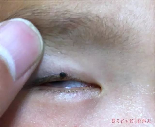                     2岁男孩眼皮上突然冒出一个小黑点！医生：这东西会要命！