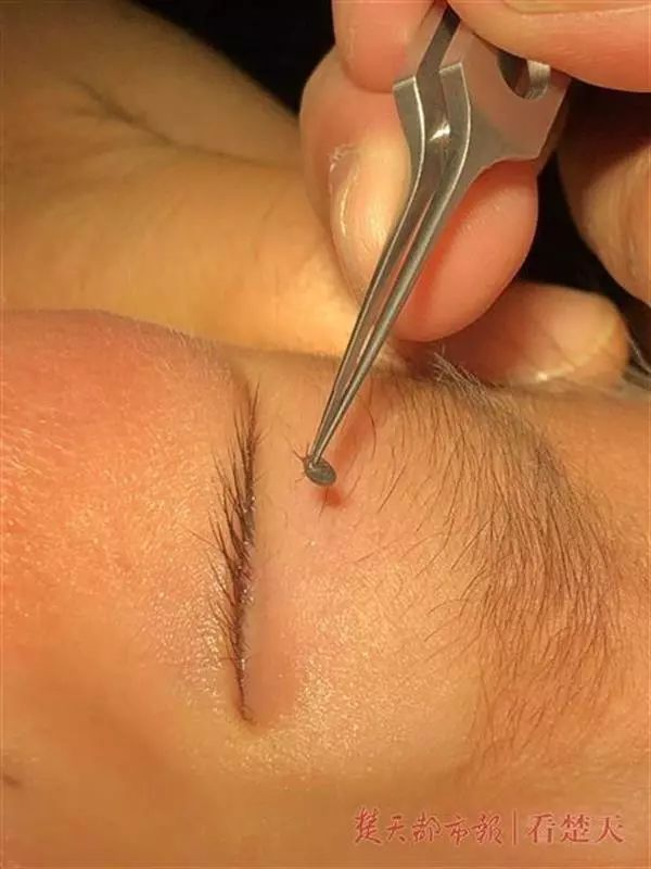                     2岁男孩眼皮上突然冒出一个小黑点！医生：这东西会要命！