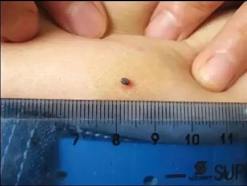                     2岁男孩眼皮上突然冒出一个小黑点！医生：这东西会要命！