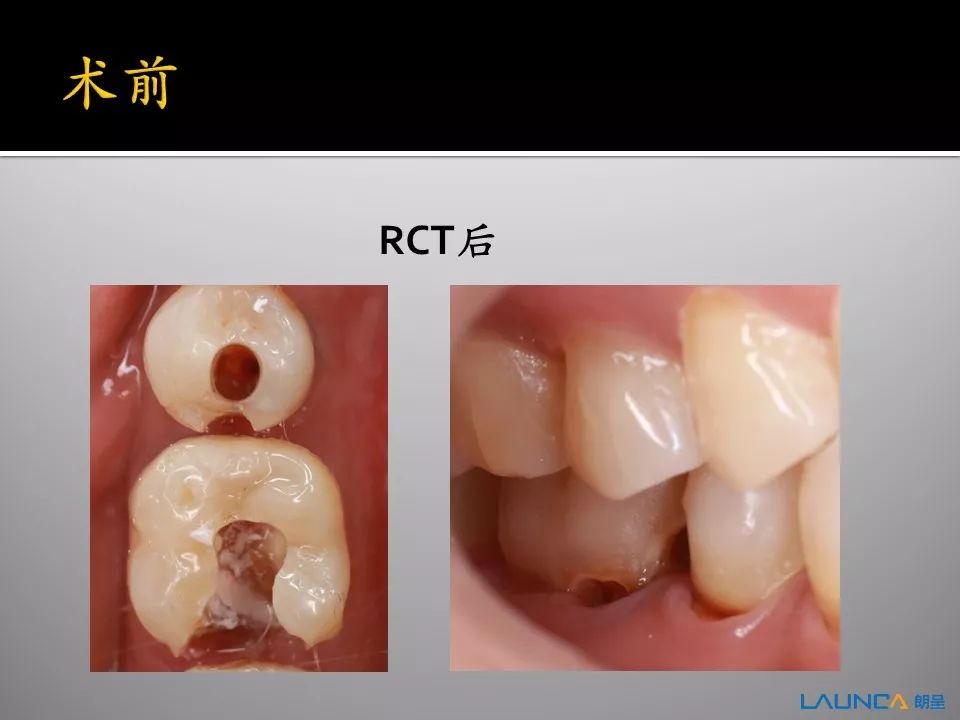 齿间技艺,指尖绽放|第二季 朗呈杯武汉第一口腔医院cad/cam病例大赛