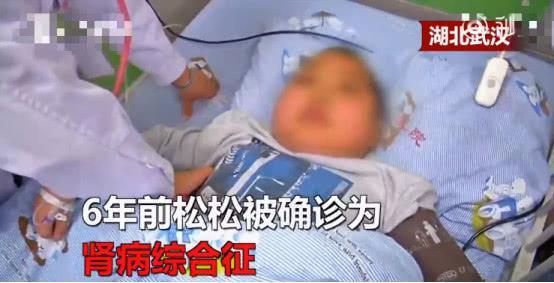                     家长让孩子停药服用民间偏方，没多久浑身变肿，医生称肾功能受损