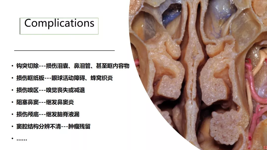 赵天智副教授前床突磨除与脑脊液漏处理中鼻道经筛入路解剖阅片与手术