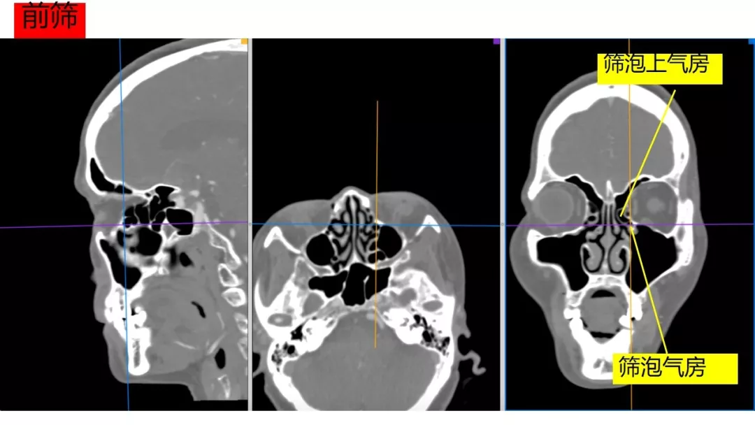 赵天智副教授 :前床突磨除与脑脊液漏处理---中鼻道经筛入路解剖,阅片