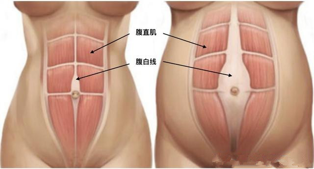                     产后腹直肌分离，肚子松松垮垮——孕期强健腹部肌肉才是关键