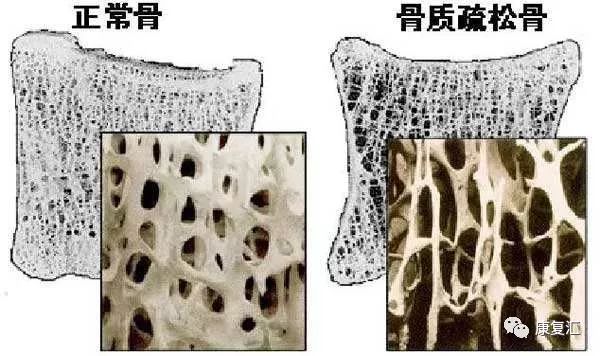 骨质疏松多久可以恢复 0637f333fcd445019a9423d89d9b1bb1.jpeg