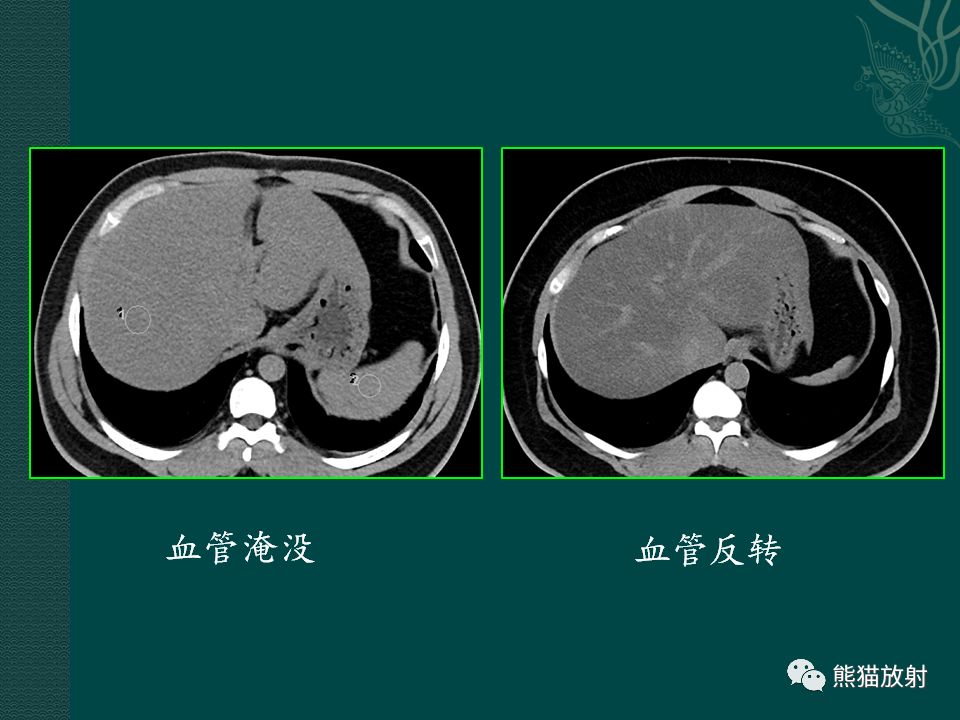 肝脏常见病变丨ct及mri诊断