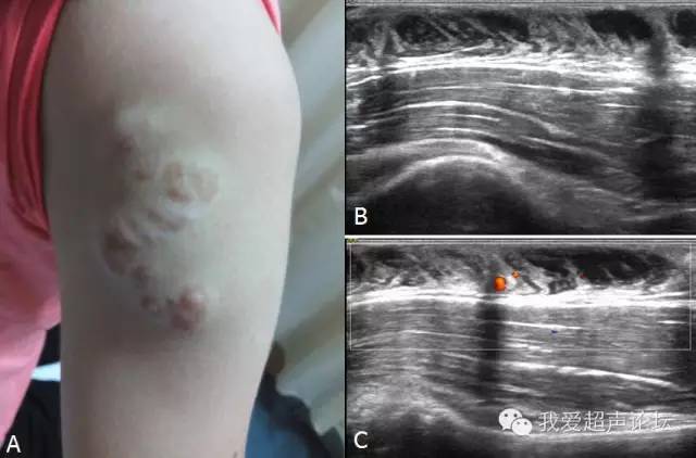 神经纤维瘤及神经鞘瘤超声诊断要点