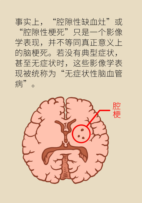 腔梗究竟是怎么回事患者平常应注意这些方面