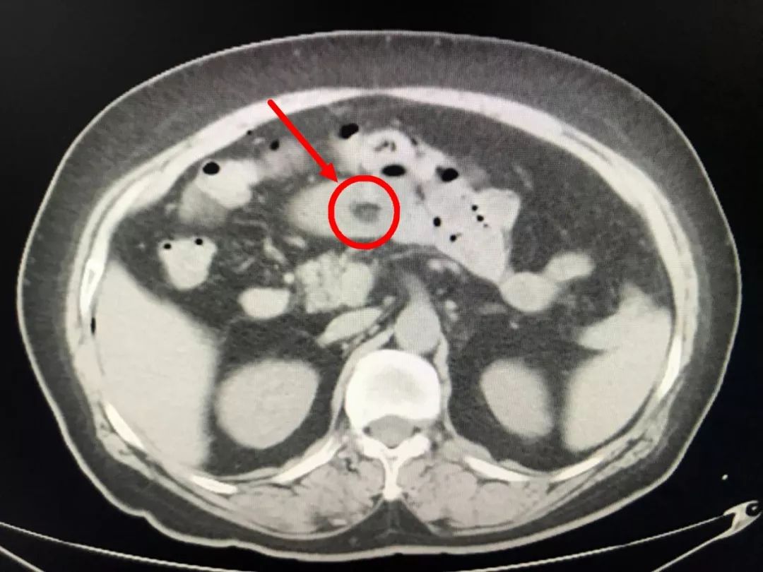 入院后,医生立即为她安排ct检查,当即确定为消化道穿孔,并能看到肠管
