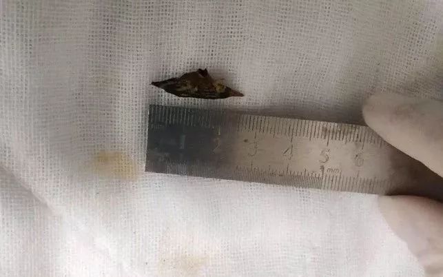                     一岁多男孩喝粥，竟致肠穿孔？家长太大意了！