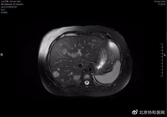 协和顺利完成神经内分泌肿瘤肝脏多发转移灶切除术 fg游乐电子美人捕鱼