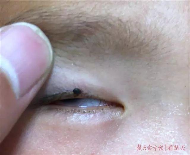 玉林侬注意!野外踏青要小心这类虫子!医生:会要命 线上赌博导航平台