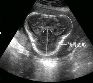                     怀孕后，多久能查出“胎儿骨骼畸形”？过了这一周，孕妈妈才放心