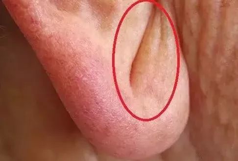 耳垂有折痕是怎么回事 7845d620bc2f4649900cd604d29ae0ec.jpeg