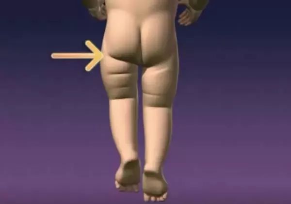                     赶紧自查！这个病等宝宝会走路才发现就晚了！