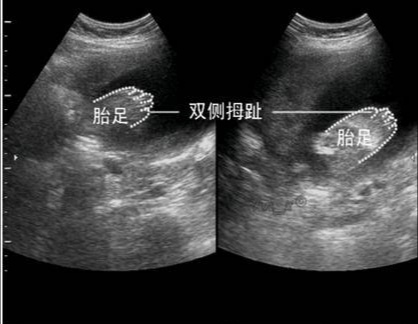                     怀孕后，多久能查出“胎儿骨骼畸形”？过了这一周，孕妈妈才放心