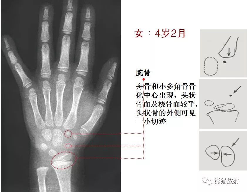 骨龄图谱保存随时对照查看