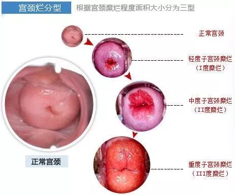 宫颈糜烂有什么,大不了做个手术烧掉!别天真了