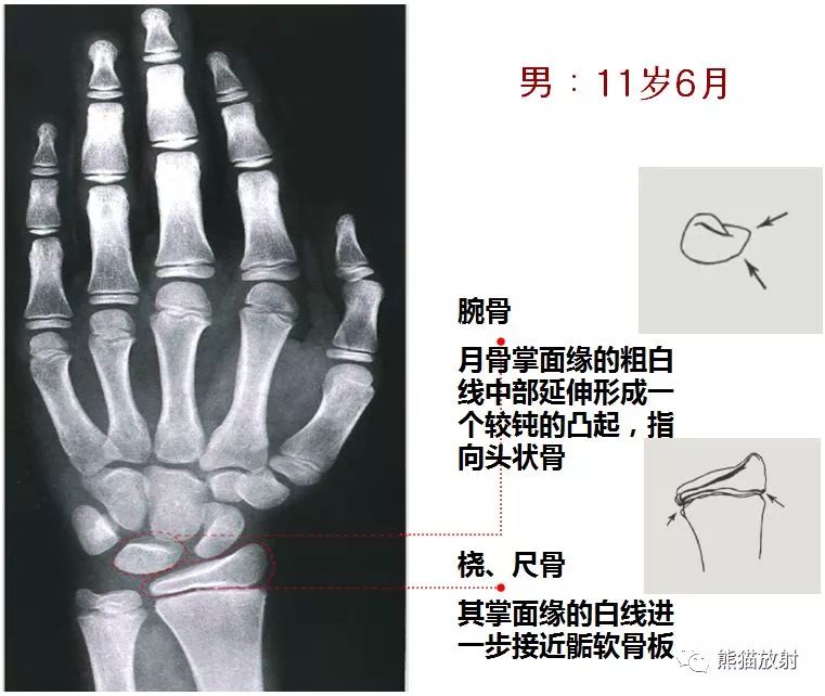 骨龄图谱保存随时对照查看