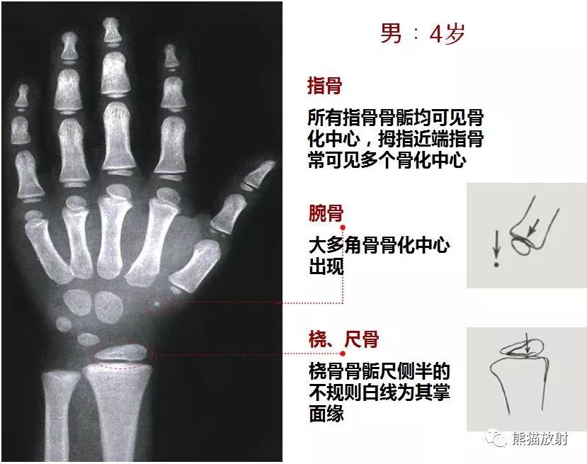 骨龄图谱保存随时对照查看