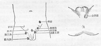 诊断双侧无睾症时,必须确认其男性染色体核型,有必要进行内分泌学