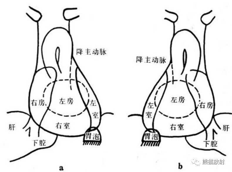 镜像右位心